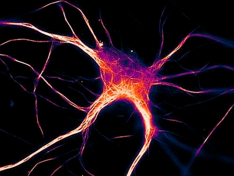 Cómo se dispersa el Alzheimer en tu cerebro