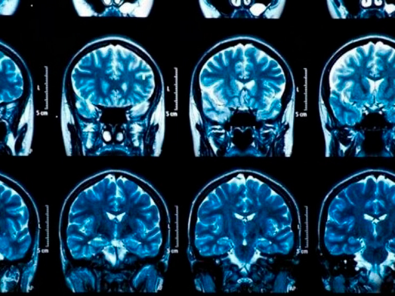 Investigadores chinos analizaron imágenes del cerebro de pacientes Covid