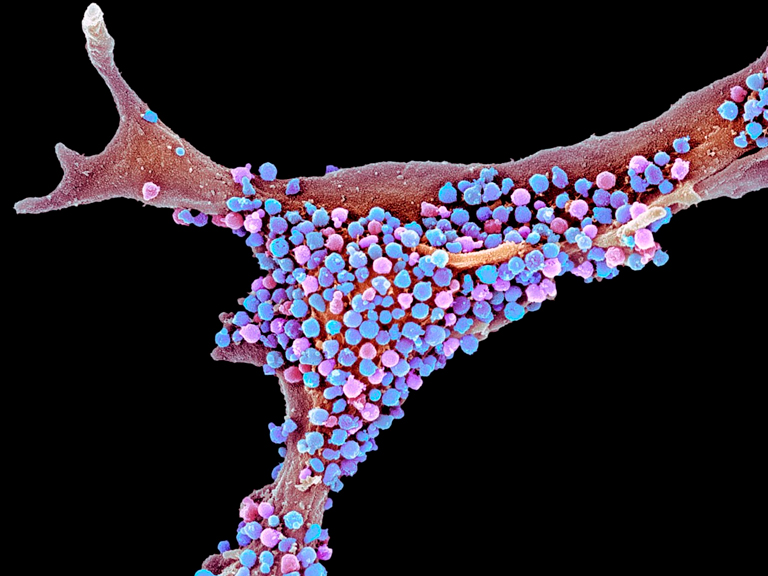 Estudio preliminar sugiere que las infecciones podrían ser la causa inicial del Alzheimer