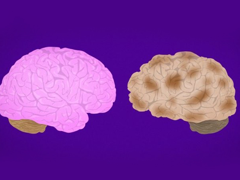 Primeros resultados: Fármaco experimental contra el Alzheimer ralentizó el deterioro cognitivo