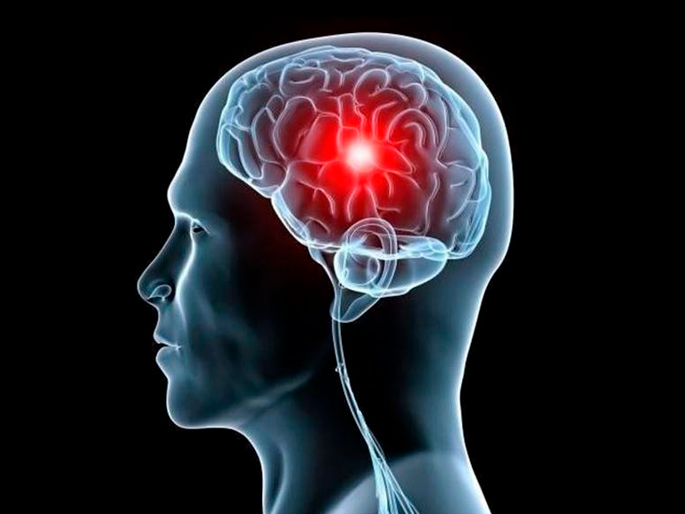 Neurociencias: los ciclos circadianos y el infarto cerebral